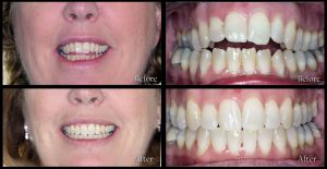 dentistry before and after discover dental