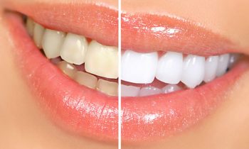 teeth whitening discover dental