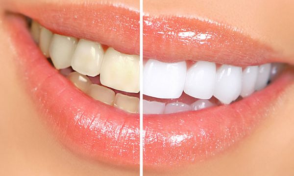 teeth whitening discover dental