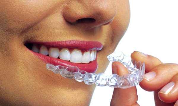 Invisalign Discover Dental