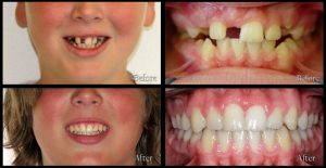 orthodontic patient before and after discover dental