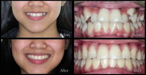 orthodontic patient 1 before and after discover dental