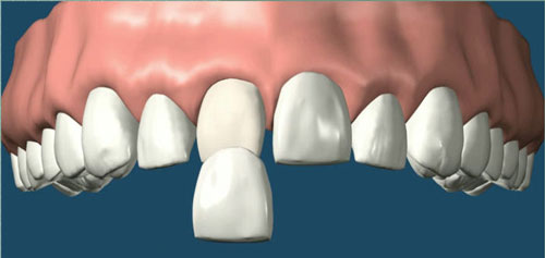 porcelain veneer discover dental