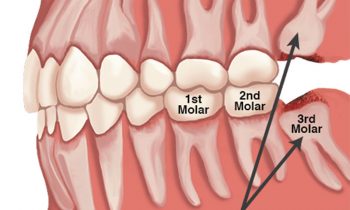 Wisdom Teeth Extractions Discover Dental