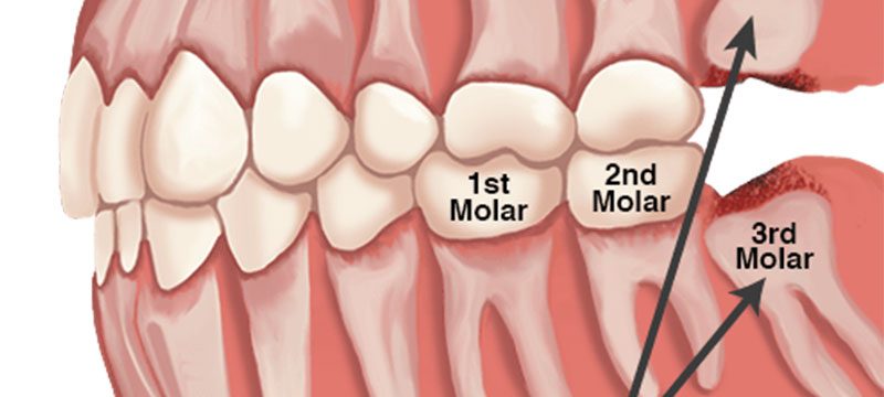 Wisdom Teeth Extractions Discover Dental