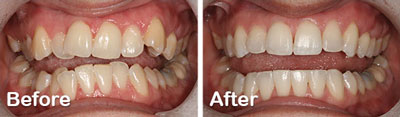 beforeafter-sixmonthsmiles1