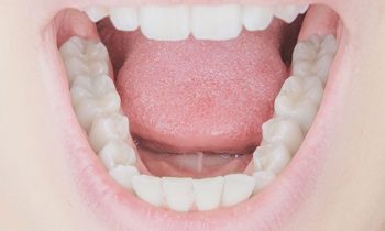 Composite Fillings Discover Dental