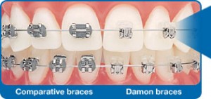 damon-braces-2-300x141