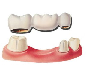 dental bridges discover dental