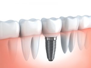 Dental Implants Discover Dental