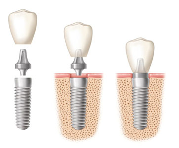 Dental Implants Pro Discover Dental