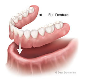 full-denture