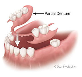 Partial Denture Discover Dental