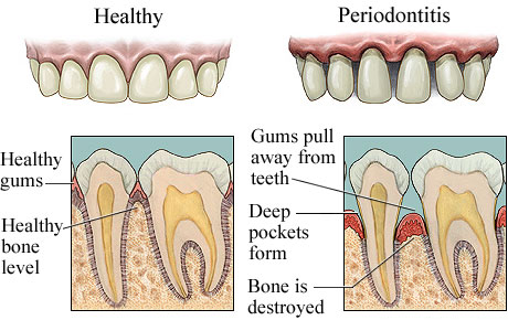 priodontal