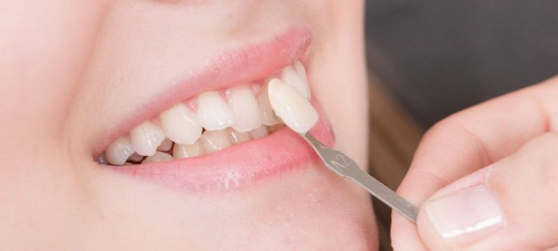 Veneers discover dental