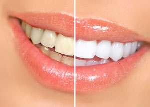 sample teeth whitening discover dental