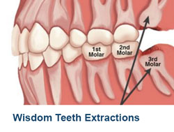 21-Wisdom-Teeth-Extractions