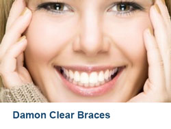 5-Damon-Clear-Braces