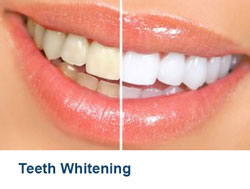 9-Teeth-Whitening